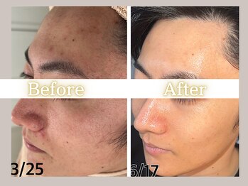 ハル(HARU.)/ハーブピーリング