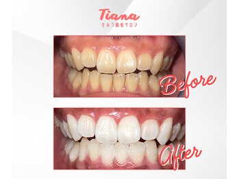 ティアナ 徳島店(Tiana)/ホワイトニング Before&After