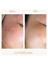 ラジェム(LA GEMME)/リピート率No.1 美顔フォト