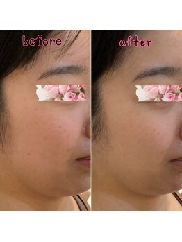 ピエール ナリタイラボ(Piel NARITAI LABO)/小顔整体