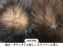 サンポ 神戸元町店(SANPO)の雰囲気（痛み・ダウンタイム無しで育毛を促し髪の毛のお悩みやトラブルに）
