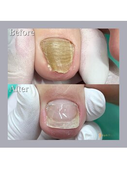 巻き爪補正店 天王寺店/元気なお爪を取り戻したい!