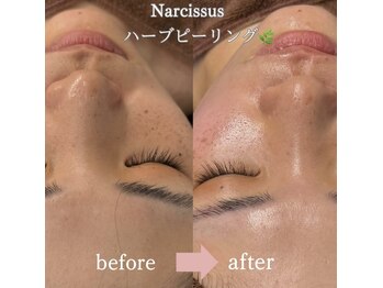 ナルシス(Narcissus)/ハーブピーリングbefore→after