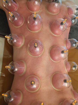 サロン ジョリ(Salon Jolie)の写真/全身の疲れを解消!カッピングで体の芯から温め代謝UP!冷え・むくみ・疲れを改善し、心身ともにリラックス♪