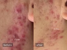 ムーマイニー(m maini)/繰り返すニキビに