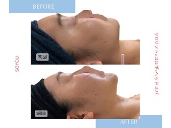 ソユ(SOYOU)/施術* 　９Dリフト