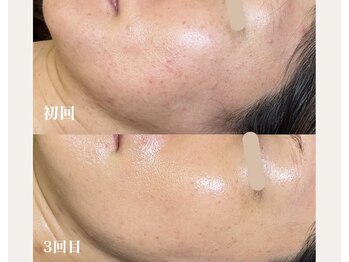 ソルニコン(Solnikon)/陶肌トリートメント