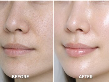 ティンク 心斎橋(Tink)の写真/[韓国肌管理*Gloss肌ピーリング]肌の深層部に浸透＆ターンオーバー促し透明感UP！憧れのウル艶水光肌に☆