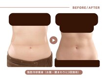 イエス マイサロン(yes My Salon)/脂肪冷却施術例
