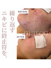 マルコ(marco)/繰り返すニキビ・肌質改善　症例