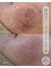 【ニキビ/肌質改善】マイクロニードル韓国式ハーブピーリング＋肌測定￥19800