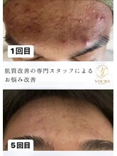 ユアーズ ビューティー(YOURS beauty) ここだけの 施術を