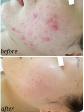 ファルファラ(farfara)/天然ハーブピーリング