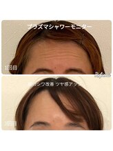 クリニカルエステ リフィーナ 辻堂店/水光プラズマビタミンシャワー