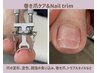 巻き爪『爪周りお掃除→巻き爪牽引→爪カット→チップで固定』親指1本45分