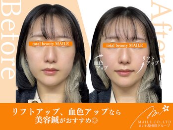 まいれ鍼灸院整骨院 整体院 大津市膳所院/美容鍼(20代女性/施術1回目)