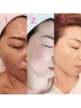 デンドロビューム(Dendrobium)/SPハーブピーリング3回施術