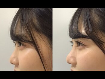 ゆうき式小顔矯正/鼻矯正before&after