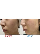 ビタミンスパ 中野店/ハーブピーリング★施術回数1回