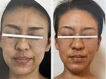 ダルセーニョ/小顔とともに「立体リフト肌」