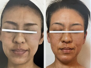 ダルセーニョ/小顔とともに「立体リフト肌」