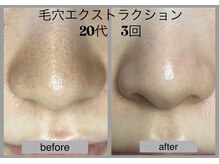 ブリノス(BLINOSS)/毛穴エクストラクション