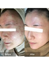 モカ 天王寺店(MOKA)/おでこニキビケア　肌トラブル