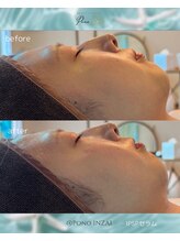 ポノ(Pono)/陶肌ピール☆一回の施術効果