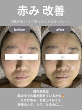 シイ(total skin beaute sii)/50代　赤みを軽減　1回