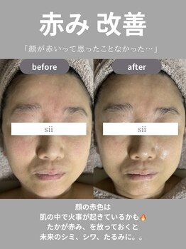 シイ(total skin beaute sii)/50代　赤みを軽減　1回