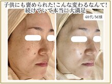 ポモナ 横浜馬車道店(Pomona)/シミケア・シミ改善美肌ケア