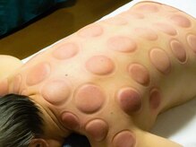 健美癒 ラ サンテ/カッピング【5】