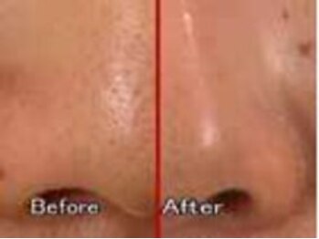 ビューティーワークス シャンティ 印西店(Beauty Works Shanti)/毛穴の黒い汚れがすっきり！