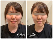 グレイスボディ BiViつくば店(Grace Body)/小顔症例写真