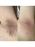  男女OK  脇ワックス＋光脱毛 (Mix脱毛)1回  ¥6500→¥5500