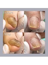 巻き爪補正店 天王寺店/変色・変形したお爪改善します