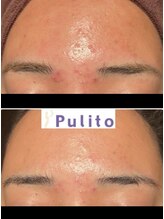プリート 銀座店(Pulito)/長年お悩みのニキビにアプローチ