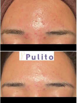 プリート 銀座店(Pulito)/長年お悩みのニキビにアプローチ
