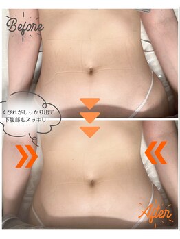 スリモア(SLIMORE)/ビフォーアフター☆お腹
