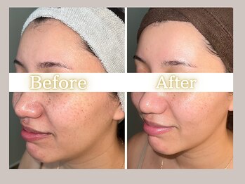 ハル(HARU.)/ハーブピーリング