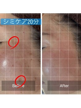 ナツミ(723)/感動シミケアメニュー！