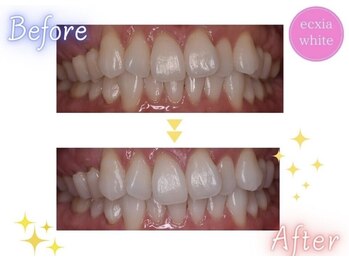 エクシアホワイトニング 天王寺店/ホワイトニングビフォーアフター