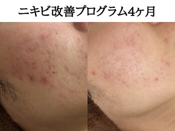 アエオボンヌール(A.E.O BONHEUR)/赤ニキビ改善経過