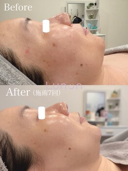 ルノン(Lunon)/毛穴洗浄ハイドロ×ララピール