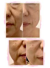 カブール 町田/ほうれい線も違いが分かる！