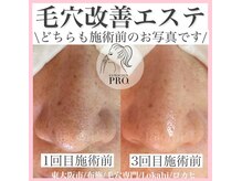 ロカヒ(Lokahi)/毛穴改善コース