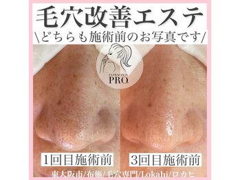 ロカヒ(Lokahi)/毛穴改善コース