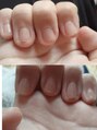 はあとねいる 青森花園店&nbsp;二年前、ジェルネイル始める前の私。爪を毟る癖がありました…