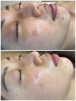 リッシュボーテ(RICHE BEAUTE)/プラズマピーリング/ビフォアフ