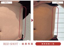 ハレア(HALEA)/レッドショット腹部 6cc B/A